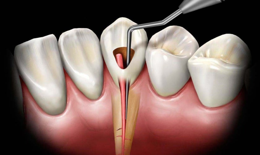 how to prevent root canal