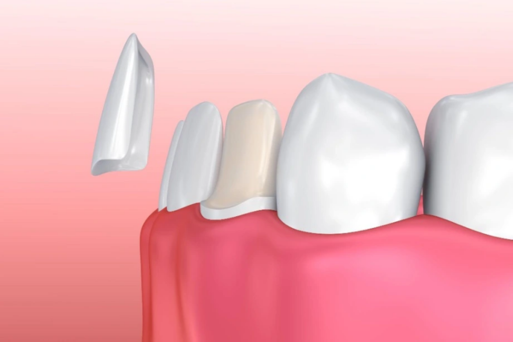 whiten your veneers