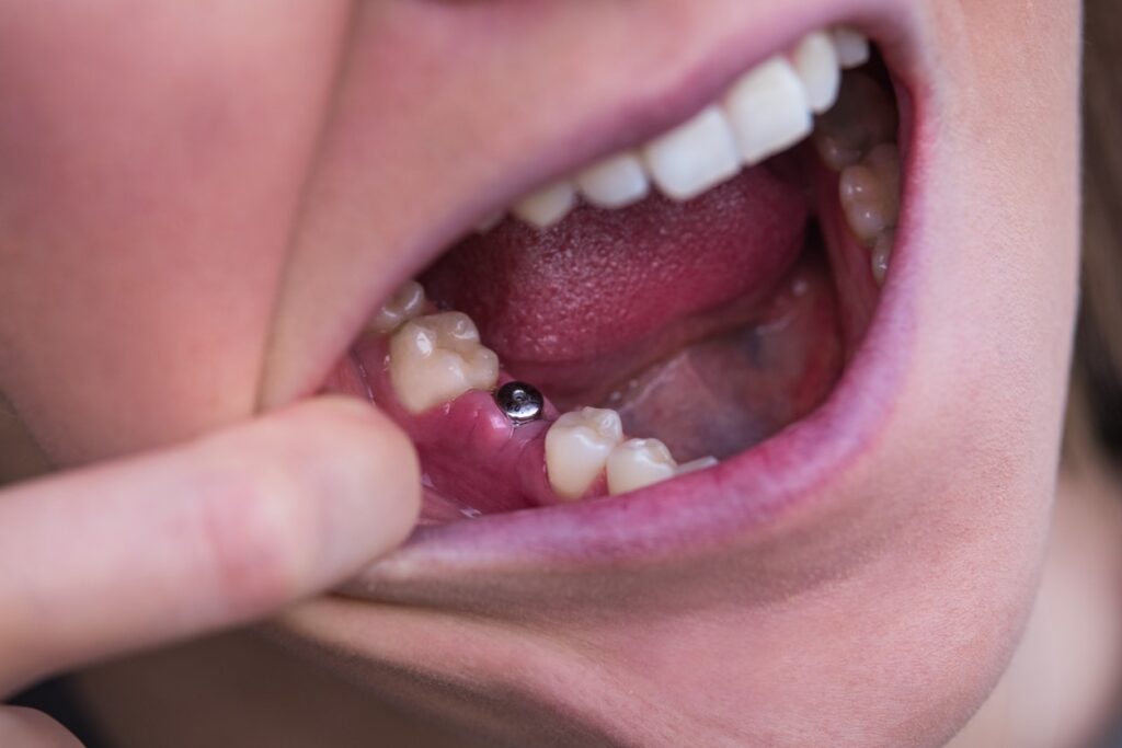 dental implant failure