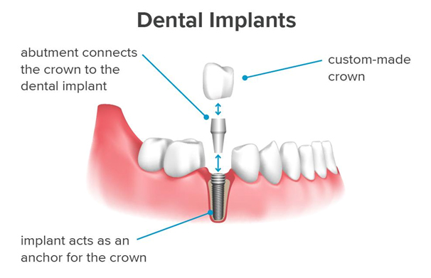 dental implants procedure
