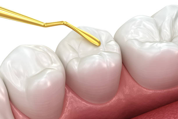 are tooth coloured fillings safe?