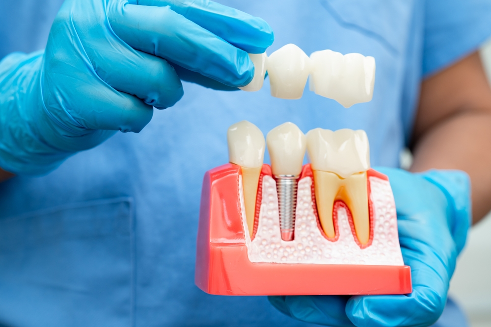 dental implants parkdale
