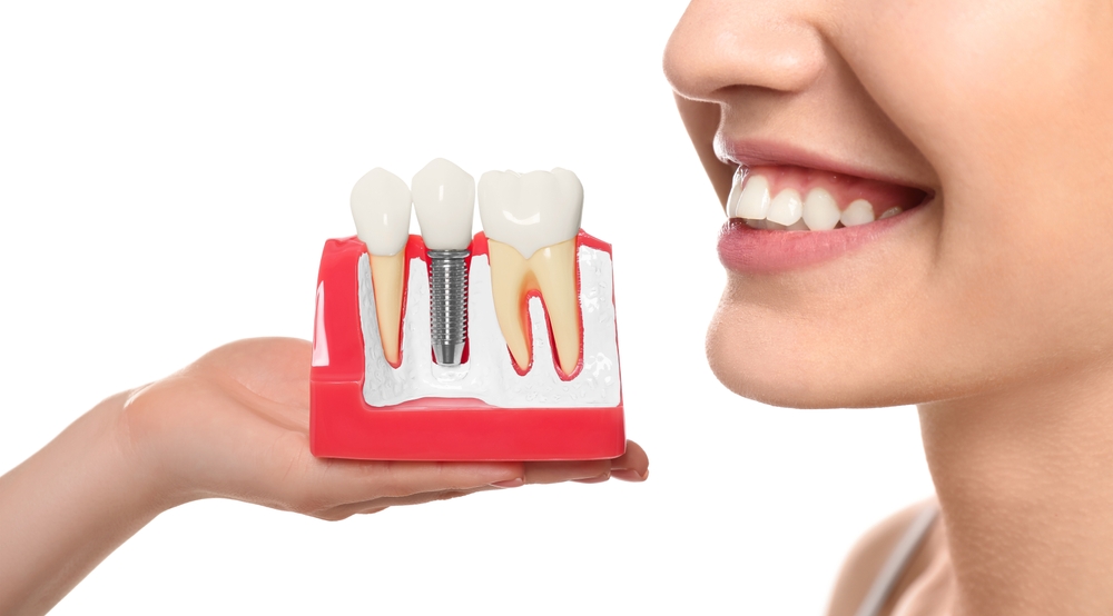 what are dental implants single vs. multiple dental implants what's the best choice