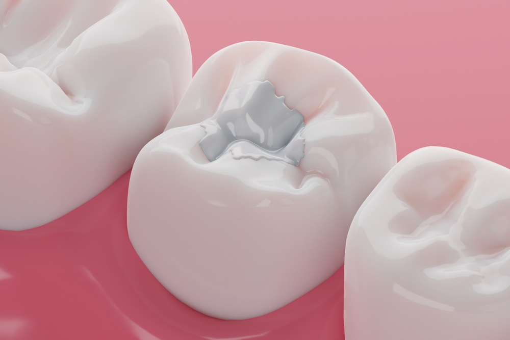 how composite fillings protect your teeth from further damage