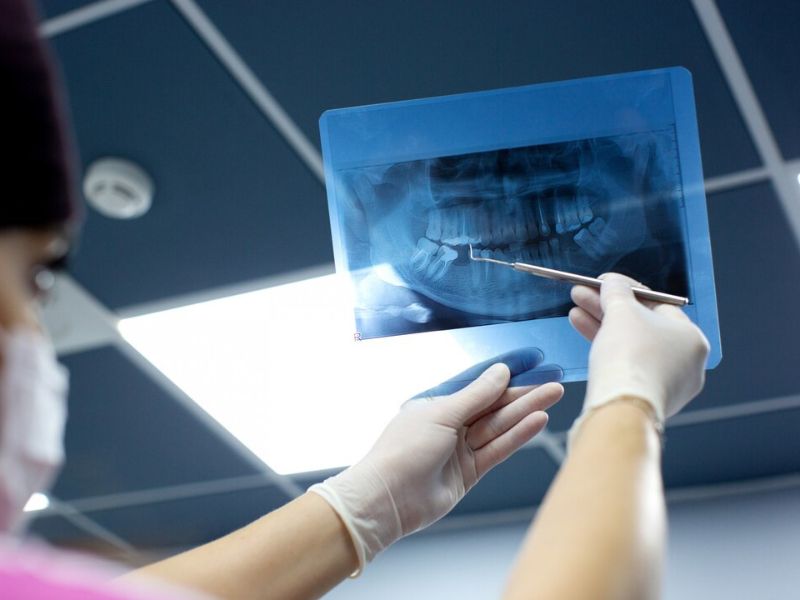 digital x-rays and dental implants why imaging matters