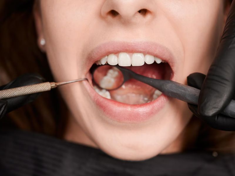 what does it feel like when wisdom teeth need to be removed